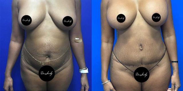Mommy Makeover result at Dr. Jeneby Plastic Surgery in San Antonio, TX