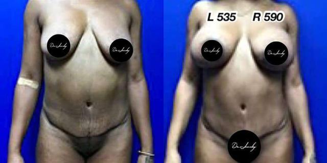 Mommy Makeover result at Dr. Jeneby Plastic Surgery in San Antonio, TX