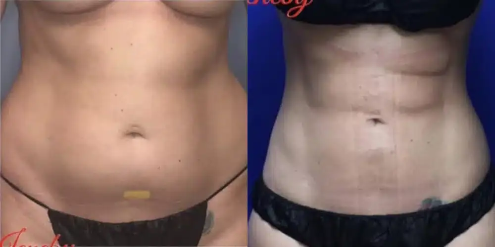 Dr. Jeneby Plastic Surgery liposuction result — San Antonio, TX