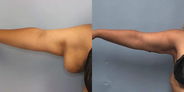 Arm Lift result at Dr. Jeneby Plastic Surgery in San Antonio, TX