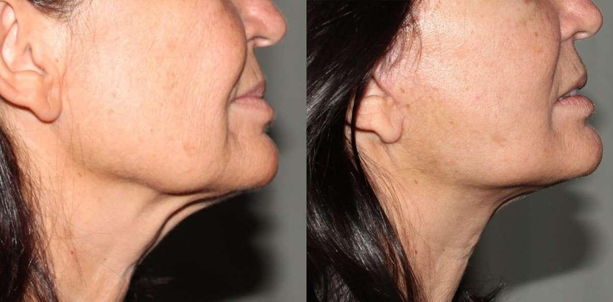 Dr. Jeneby Plastic Surgery neck lift result — San Antonio, TX