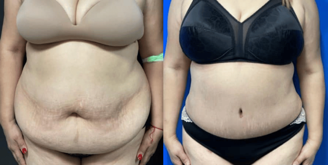 Mini Tummy Tuck result at Dr. Jeneby Plastic Surgery in San Antonio, TX