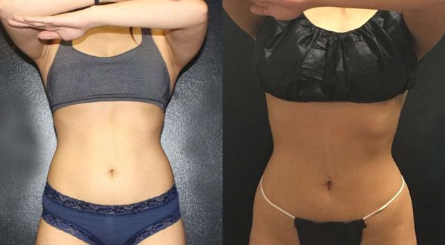 CoolSculpting result at Dr. Jeneby Plastic Surgery in San Antonio, TX