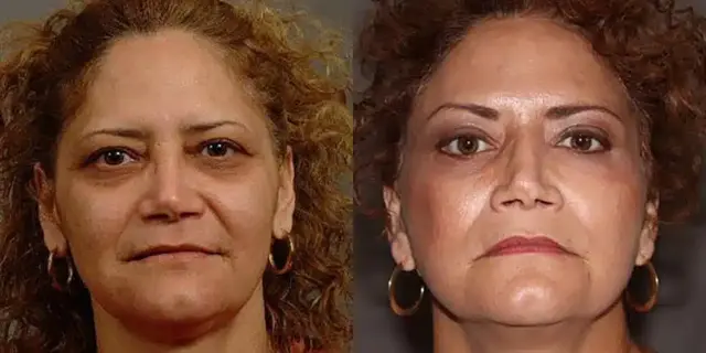 Deep Plane Facelift result at Dr. Jeneby Plastic Surgery in San Antonio, TX
