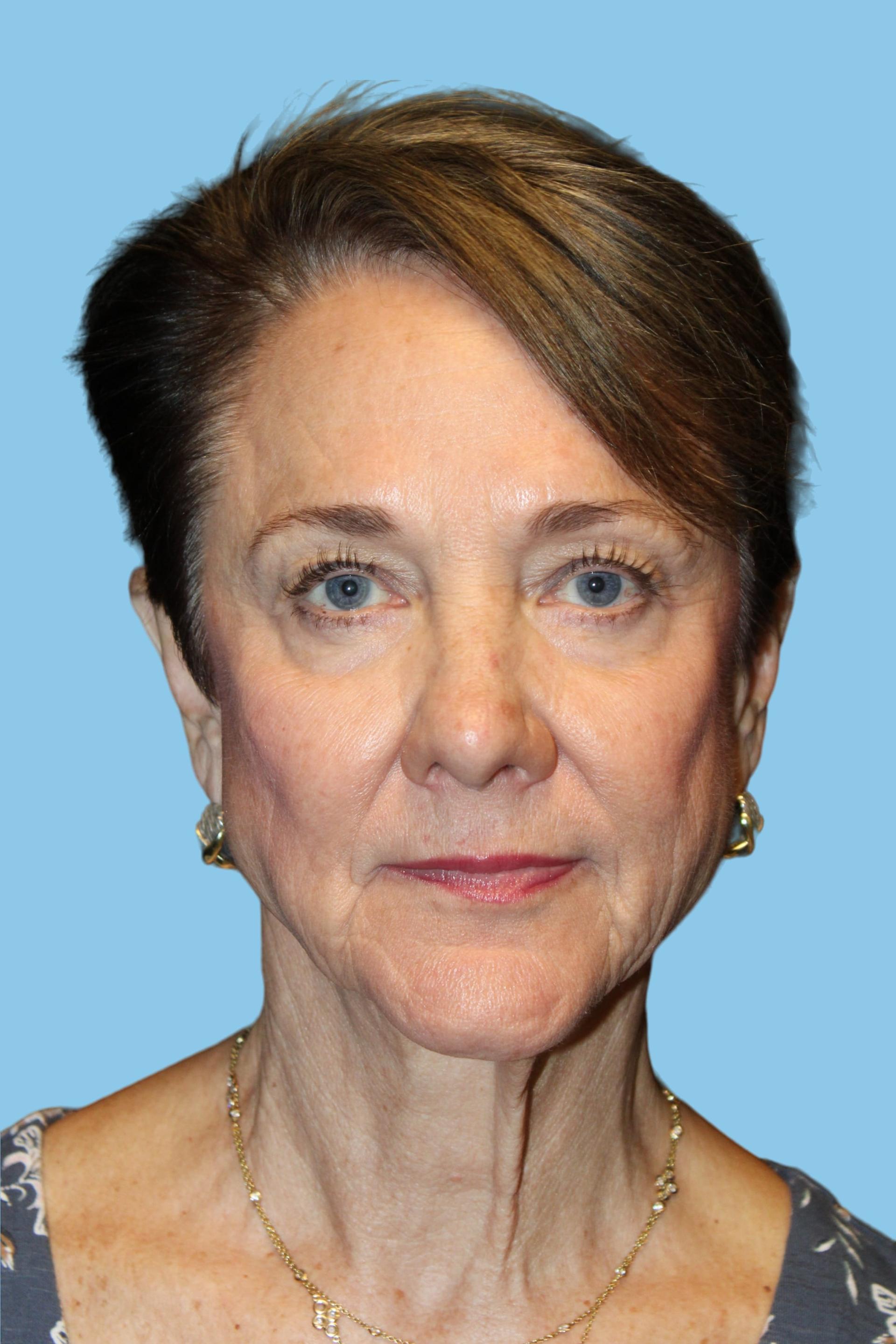 Warner Aesthetic & Reconstructive Institute skin tightening after — Northfield, IL