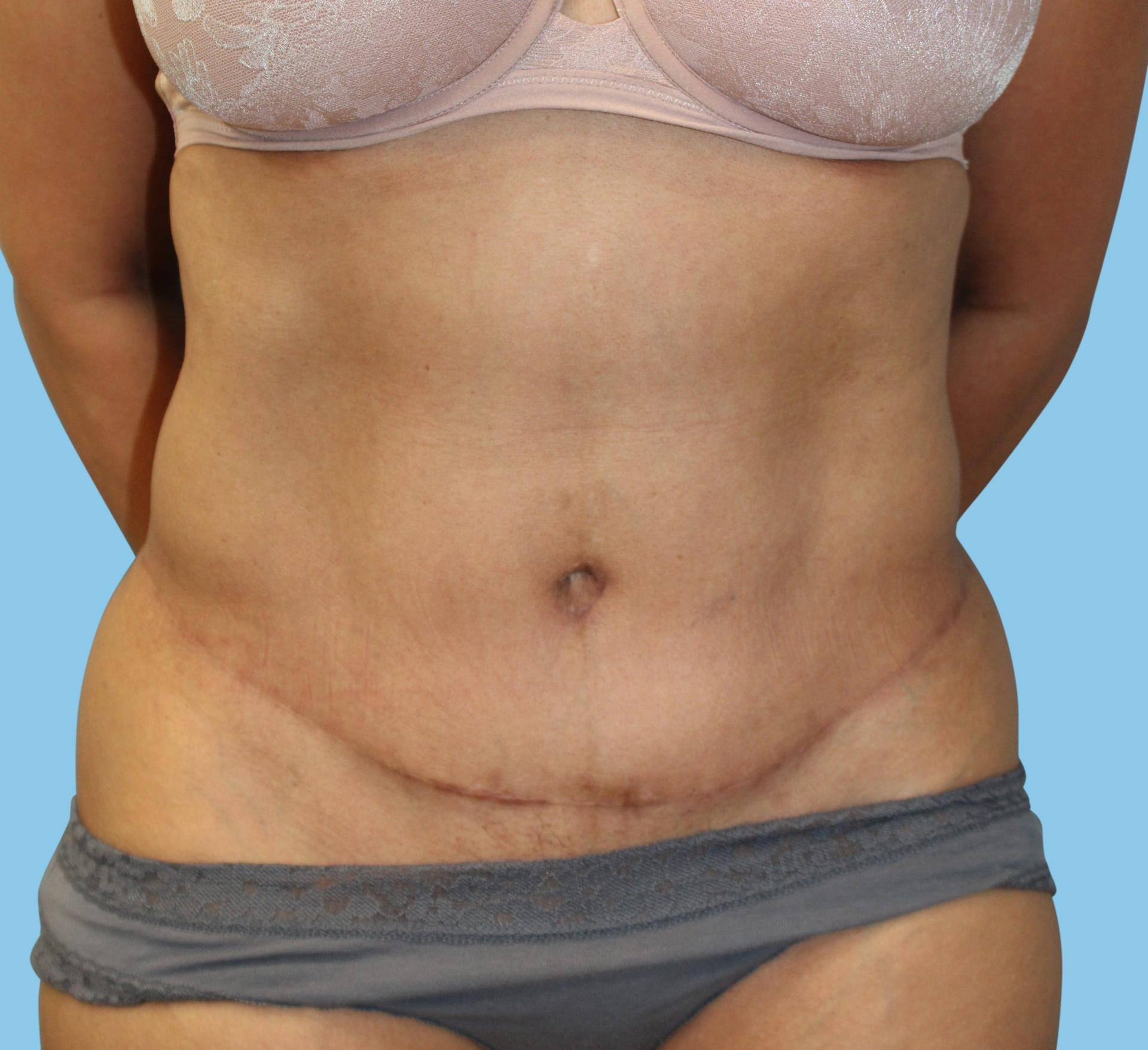 Warner Aesthetic & Reconstructive Institute tummy tuck after — Northfield, IL
