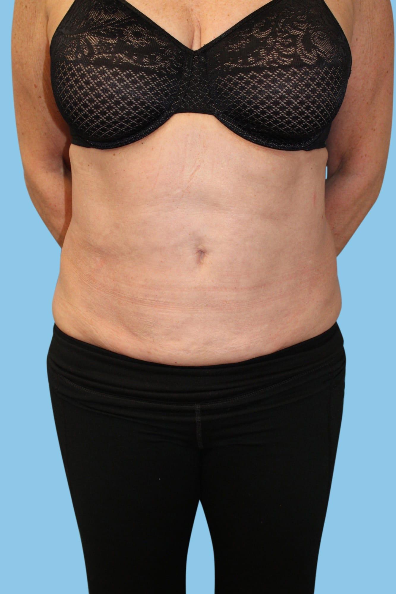 Warner Aesthetic & Reconstructive Institute skin tightening after — Northfield, IL