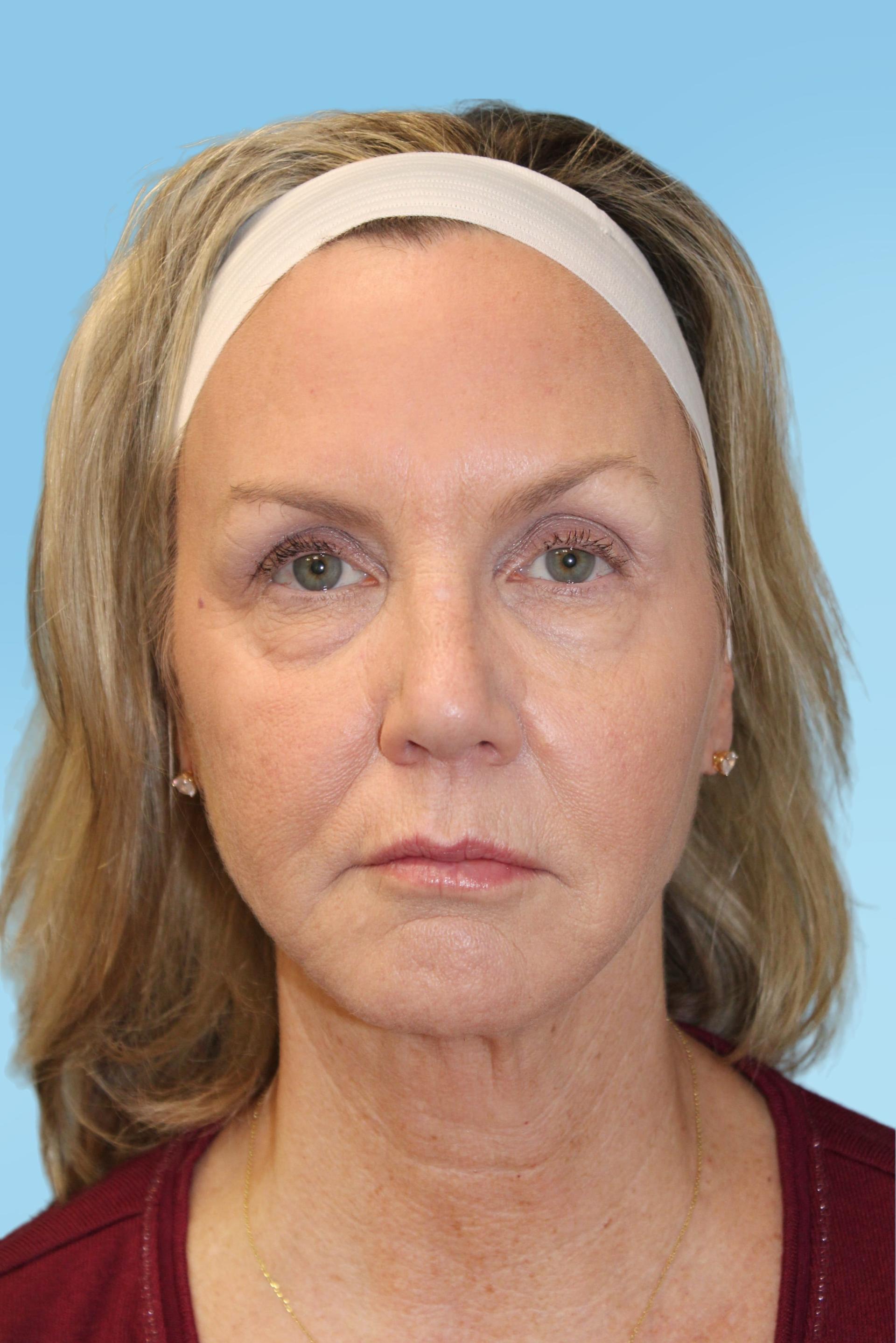 Warner Aesthetic & Reconstructive Institute skin tightening after — Northfield, IL