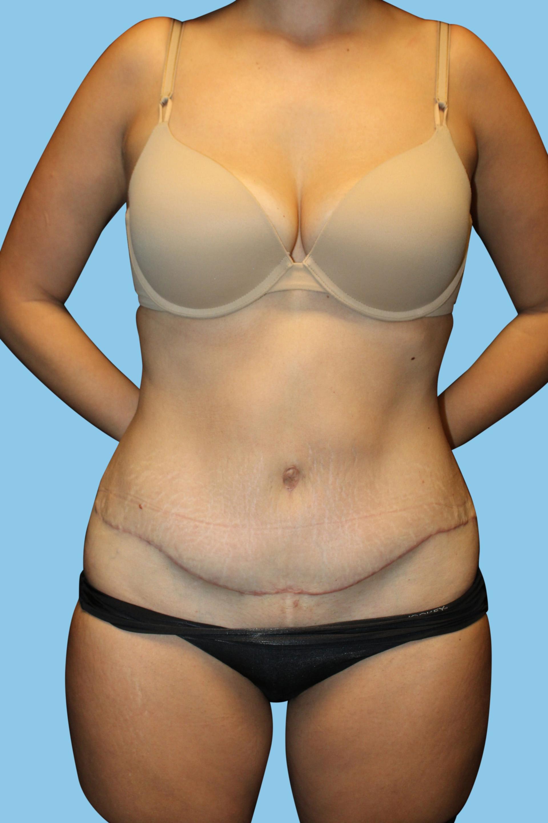 Warner Aesthetic & Reconstructive Institute tummy tuck after — Northfield, IL
