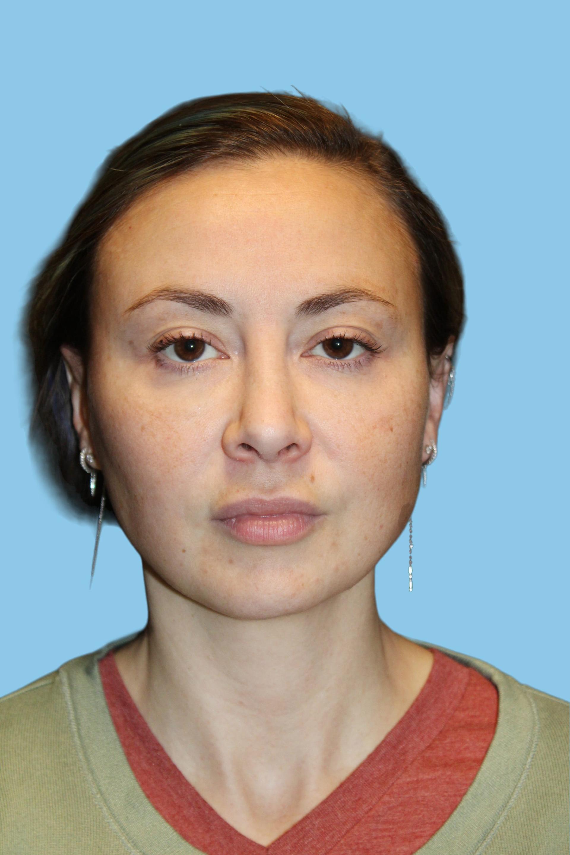 Warner Aesthetic & Reconstructive Institute skin tightening after — Northfield, IL