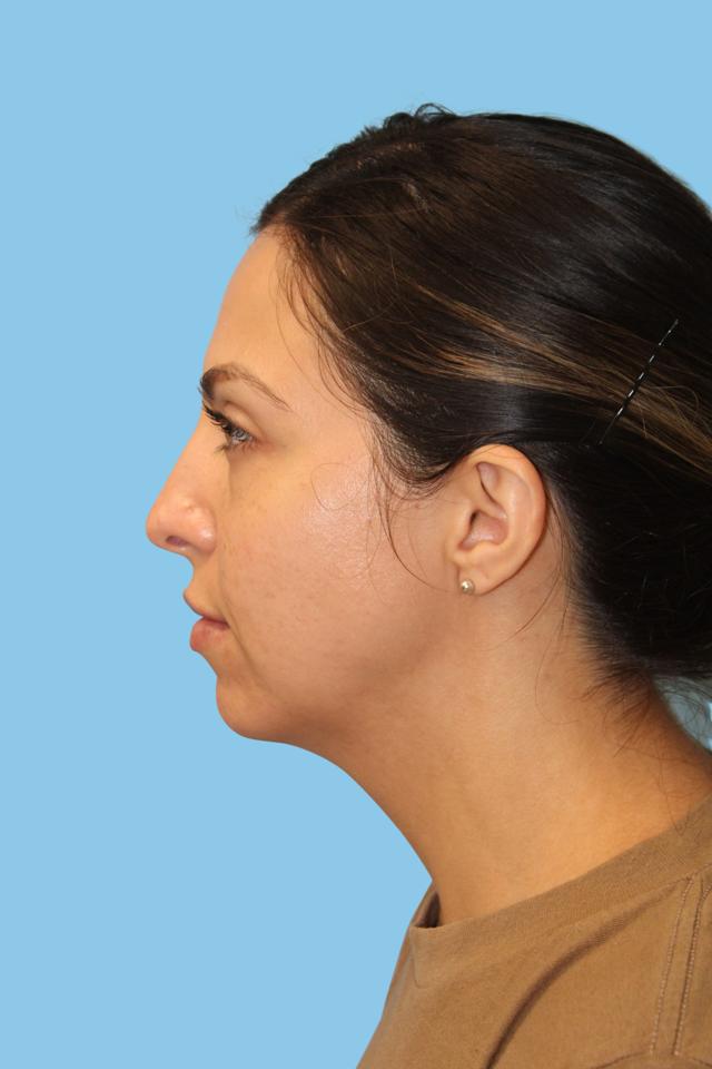 Chin Implant before at Warner Aesthetic & Reconstructive Institute in Northfield, IL