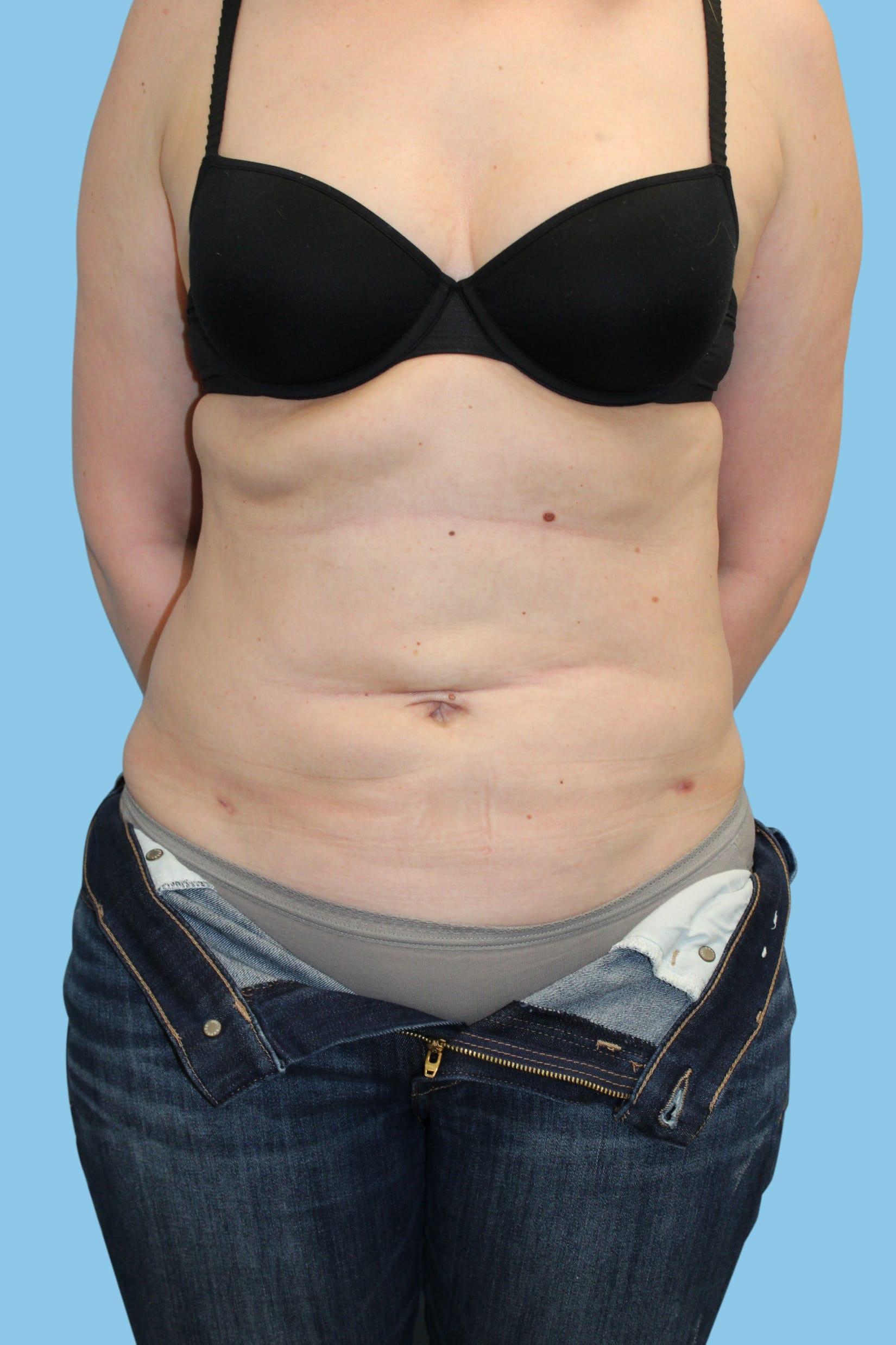 Warner Aesthetic & Reconstructive Institute skin tightening after — Northfield, IL