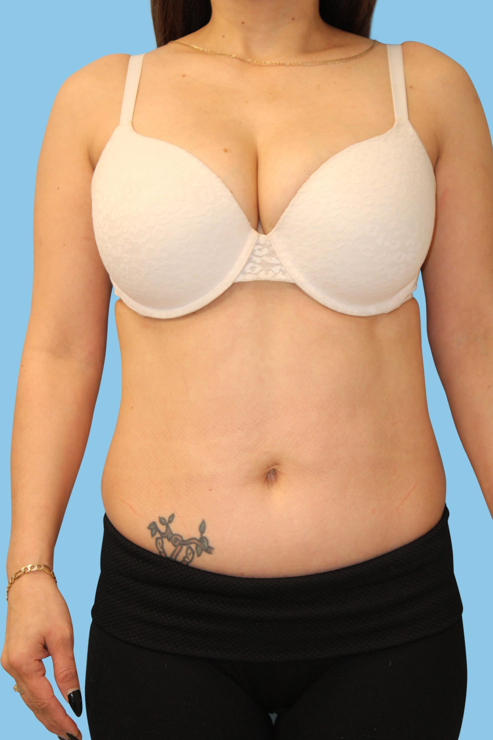 Warner Aesthetic & Reconstructive Institute tummy tuck after — Northfield, IL