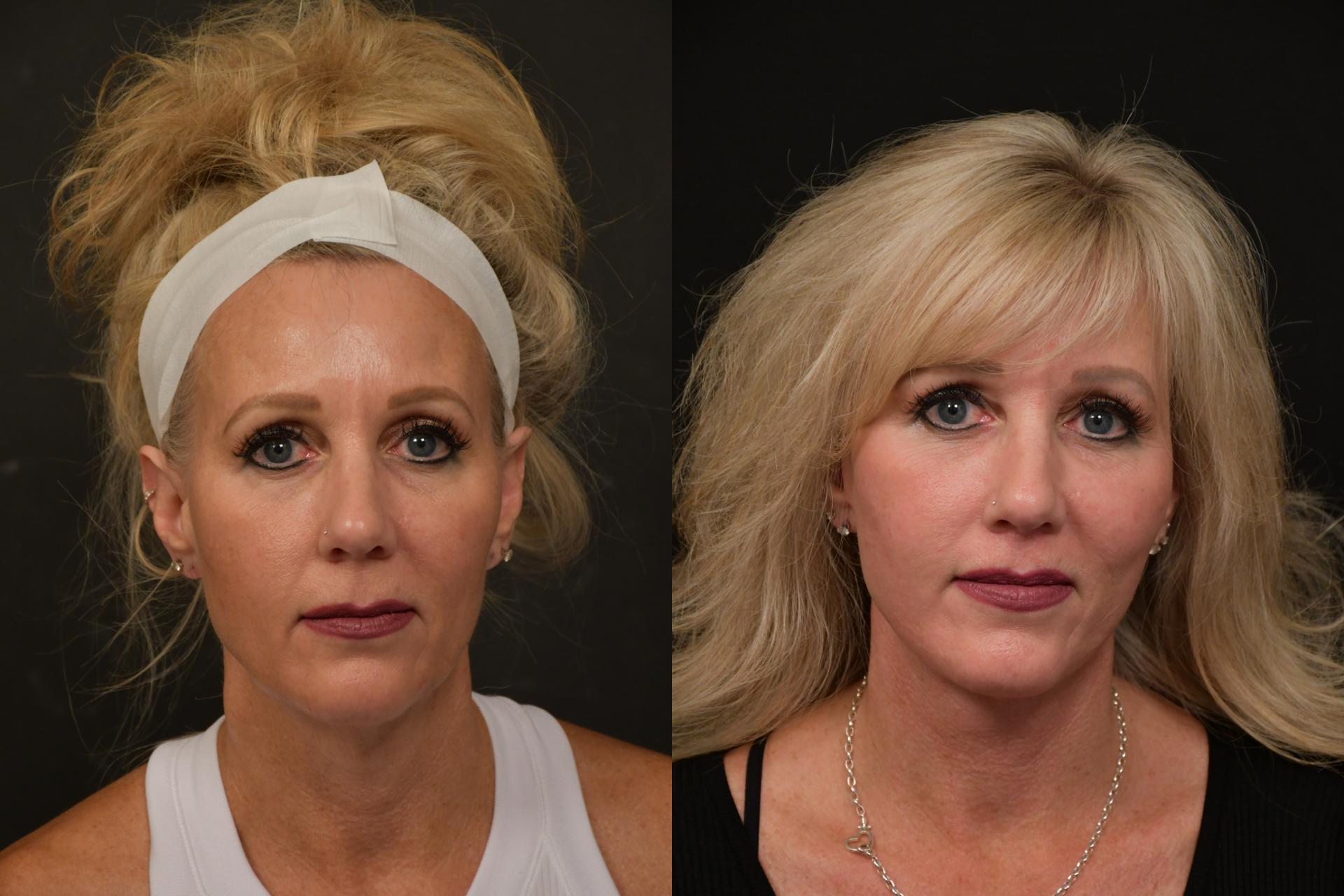 Changes Plastic Surgery & Spa lip lift result — San Diego, CA