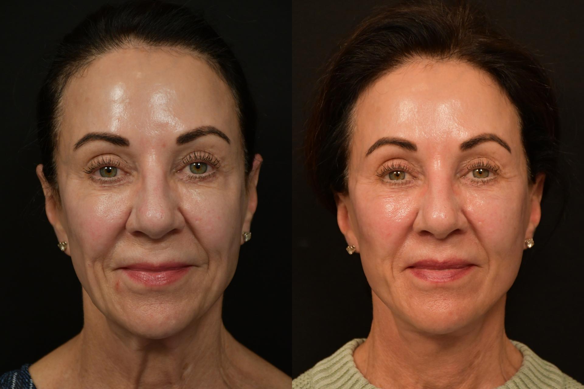 Changes Plastic Surgery & Spa lip lift result — San Diego, CA