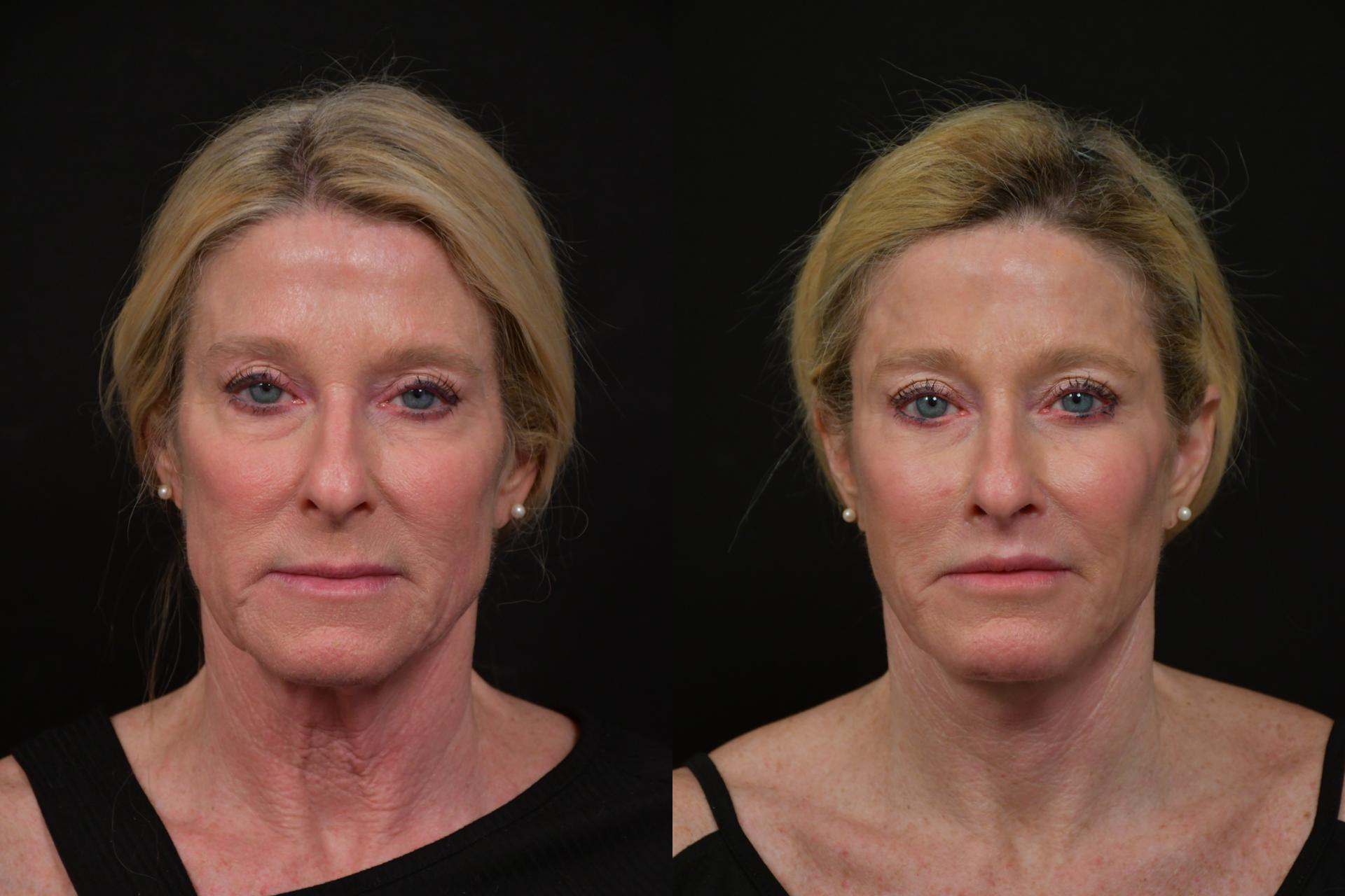 Changes Plastic Surgery & Spa lip lift result — San Diego, CA