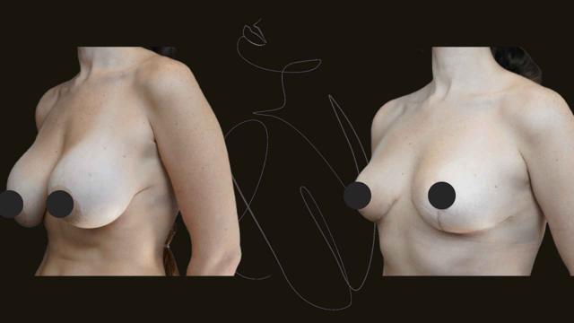 Breast Lift result at Itay Wiser MD in New York, NY