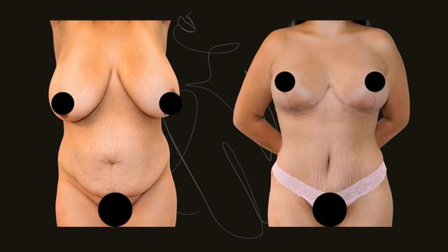 Mommy Makeover result at Itay Wiser MD in New York, NY