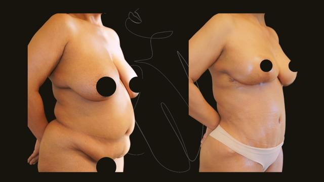 Mommy Makeover result at Itay Wiser MD in New York, NY
