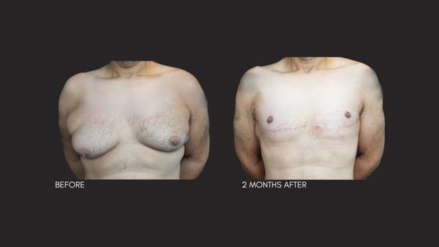 Gynecomastia Surgery result at Itay Wiser MD in New York, NY