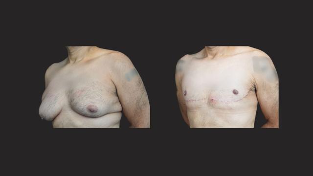 Gynecomastia Surgery result at Itay Wiser MD in New York, NY