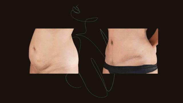 Tummy Tuck result at Itay Wiser MD in New York, NY