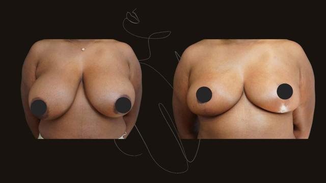 Breast Reduction result at Itay Wiser MD in New York, NY