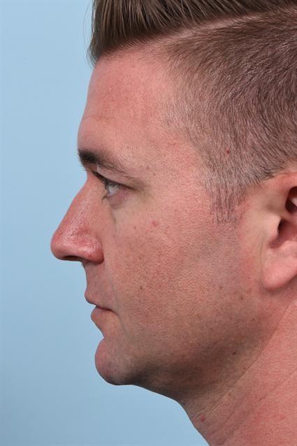 Dermal Fillers before at La Jolla Facial Plastic Surgery: Victor Chung, MD in San Diego, CA