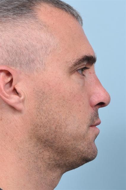 La Jolla Facial Plastic Surgery: Victor Chung, MD rhinoplasty after — San Diego, CA
