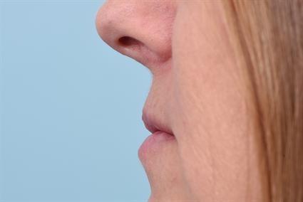 Lip Filler before at La Jolla Facial Plastic Surgery: Victor Chung, MD in San Diego, CA