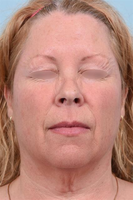 Botox after at La Jolla Facial Plastic Surgery: Victor Chung, MD in San Diego, CA