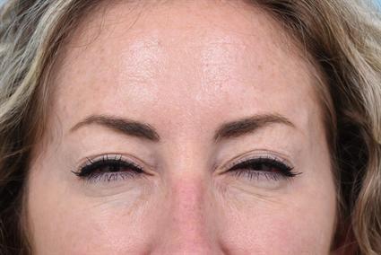 Botox after at La Jolla Facial Plastic Surgery: Victor Chung, MD in San Diego, CA