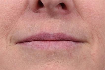 Lip Filler before at La Jolla Facial Plastic Surgery: Victor Chung, MD in San Diego, CA