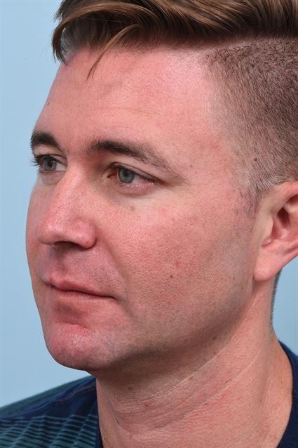 Dermal Fillers after at La Jolla Facial Plastic Surgery: Victor Chung, MD in San Diego, CA