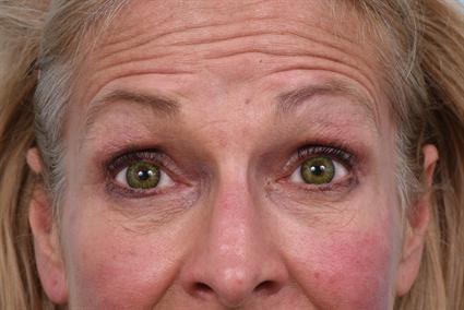 Botox before at La Jolla Facial Plastic Surgery: Victor Chung, MD in San Diego, CA