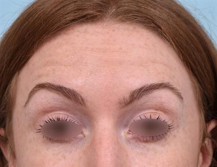 Botox after at La Jolla Facial Plastic Surgery: Victor Chung, MD in San Diego, CA