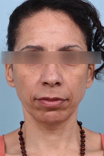 Dermal Fillers before at La Jolla Facial Plastic Surgery: Victor Chung, MD in San Diego, CA