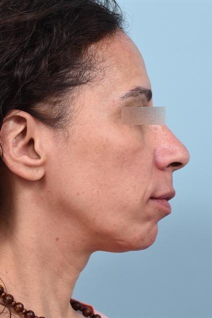 Dermal Fillers after at La Jolla Facial Plastic Surgery: Victor Chung, MD in San Diego, CA