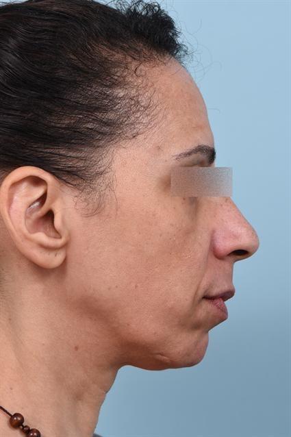 Dermal Fillers before at La Jolla Facial Plastic Surgery: Victor Chung, MD in San Diego, CA