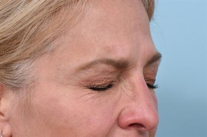 Botox after at La Jolla Facial Plastic Surgery: Victor Chung, MD in San Diego, CA
