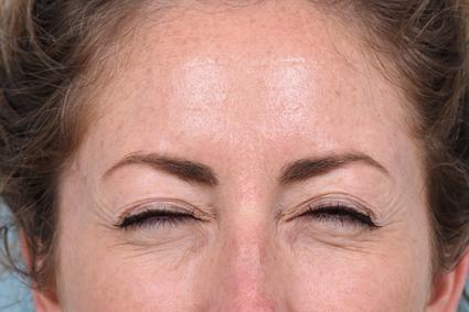 Botox before at La Jolla Facial Plastic Surgery: Victor Chung, MD in San Diego, CA