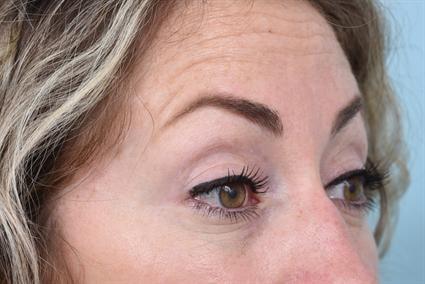 La Jolla Facial Plastic Surgery: Victor Chung, MD botox after — San Diego, CA