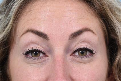 La Jolla Facial Plastic Surgery: Victor Chung, MD botox after — San Diego, CA