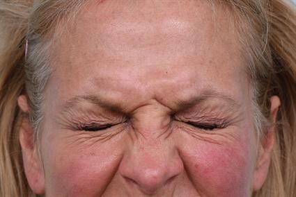 Botox before at La Jolla Facial Plastic Surgery: Victor Chung, MD in San Diego, CA