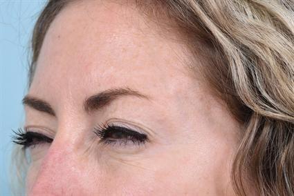 La Jolla Facial Plastic Surgery: Victor Chung, MD botox after — San Diego, CA