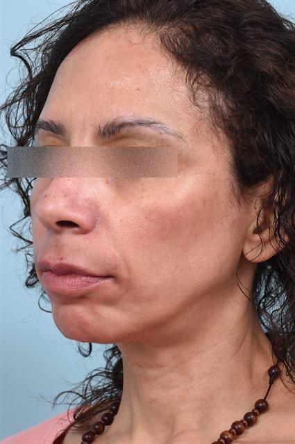 Dermal Fillers after at La Jolla Facial Plastic Surgery: Victor Chung, MD in San Diego, CA