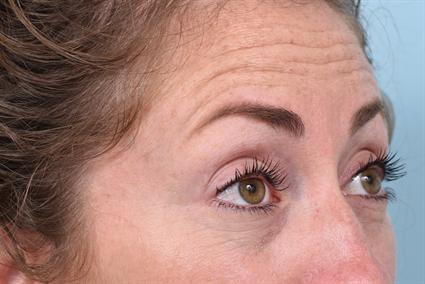 Botox before at La Jolla Facial Plastic Surgery: Victor Chung, MD in San Diego, CA