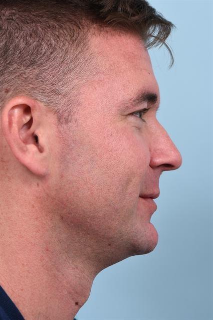 Dermal Fillers after at La Jolla Facial Plastic Surgery: Victor Chung, MD in San Diego, CA