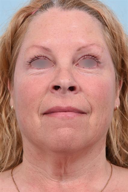 Botox after at La Jolla Facial Plastic Surgery: Victor Chung, MD in San Diego, CA