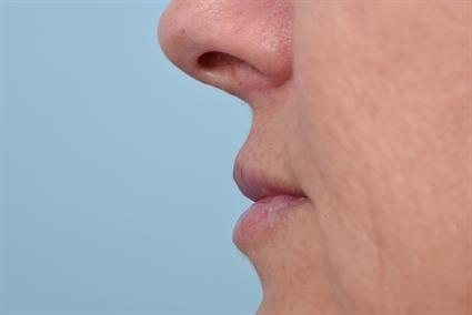 Lip Filler after at La Jolla Facial Plastic Surgery: Victor Chung, MD in San Diego, CA